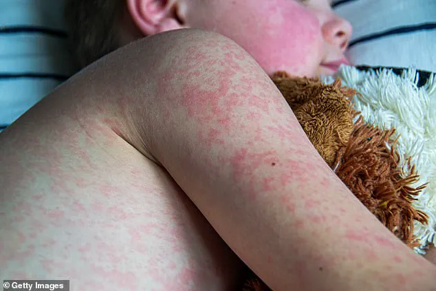 Measles Cases Soar in America: CDC Reports Yearly Milestone Surpassed in Just Three Months