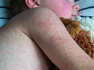 Vaccinated Teacher Contracts Measles: Urgent Public Health Warning Issued