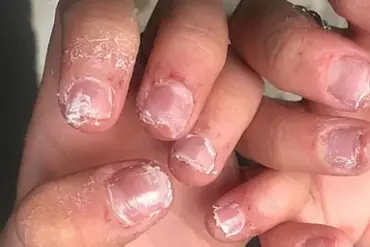 Audiologist Warns of Ear Cleaning Dangers with Fake Nails