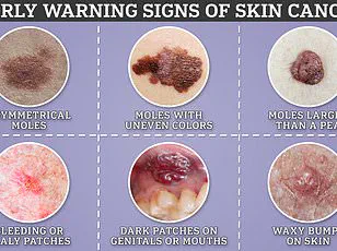 Beyond Appearance: How Mole Sensations Can Indicate Deadly Skin Cancer