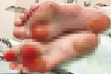 Doctors Warn of Severe Burns From Walking Barefoot on Hot Asphalt During Summer Heat