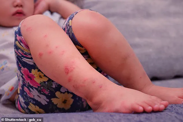 Fifty Michigan Residents Potentially Exposed to Measles as Toddler Spreads Virus Across Multiple Locations