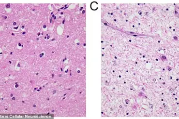 Oregon Reports Two Fatal Cases of Creutzfeldt-Jakob Disease in Hood River County