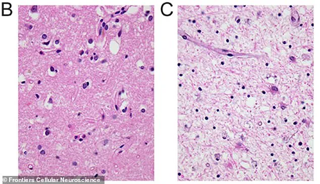 Oregon Reports Two Fatal Cases of Creutzfeldt-Jakob Disease in Hood River County
