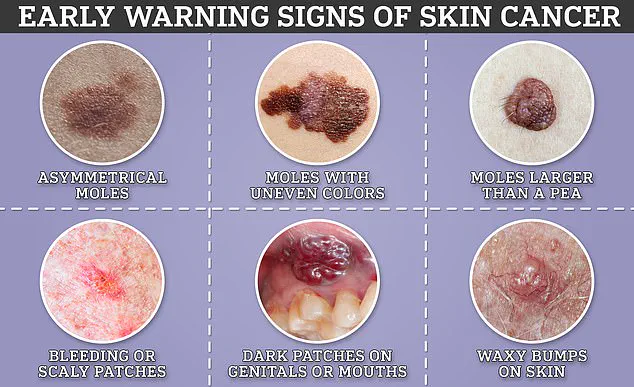 Understanding Mucosal Melanoma: A Rare but Serious Form of Cancer in the UK