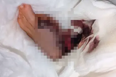 From DIY Ritual to Medical Crisis: The Unseen Risks of Self-Administered Pedicures