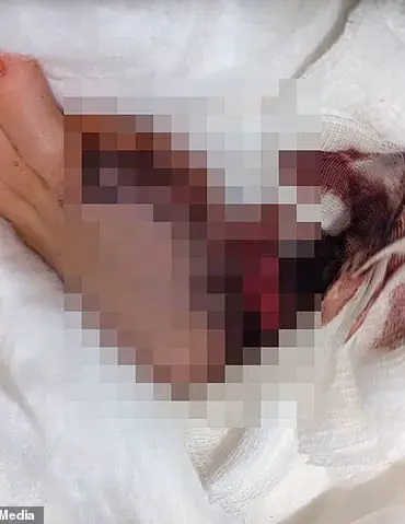 From DIY Ritual to Medical Crisis: The Unseen Risks of Self-Administered Pedicures