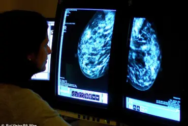 Proposed Expansion of Breast Cancer Screening to Women in Their 30s Sparks Debate Over Early Detection Risks and Benefits in England