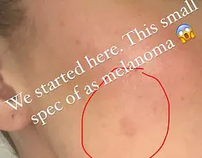 A Hidden Threat: Misdiagnosed Cyst Reveals Deadly Melanoma, Highlighting Community Health Risks