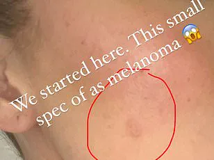 A Hidden Threat: Misdiagnosed Cyst Reveals Deadly Melanoma, Highlighting Community Health Risks