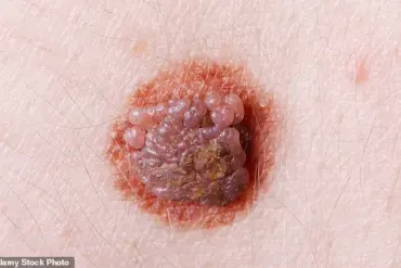 Decoding the Skin’s Signals: Early Signs of Health Issues Revealed by Experts