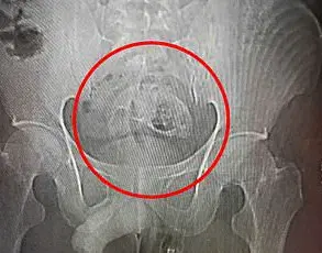 Doctors Sound Alarm Over Rare Cases of Bowel Evisceration Linked to Prolonged Coughing During Allergy Season