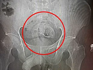 Doctors Sound Alarm Over Rare Cases of Bowel Evisceration Linked to Prolonged Coughing During Allergy Season