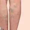 Behind the Spotlight: David Tag's Personal Story on Living with Varicose Veins