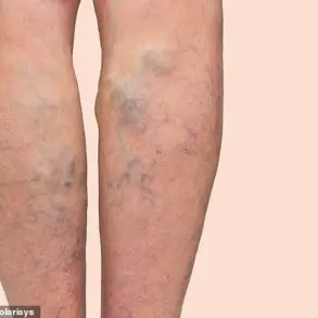 Behind the Spotlight: David Tag's Personal Story on Living with Varicose Veins