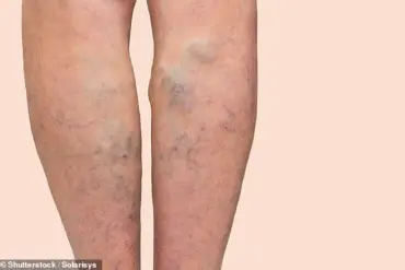 Behind the Spotlight: David Tag's Personal Story on Living with Varicose Veins
