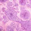 Breakthrough in Breast Cancer Research: New Mechanism Reveals How Cancer Spreads and Opens Doors for Early Treatment