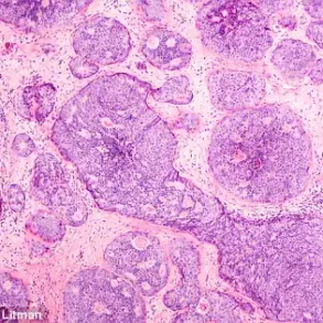 Breakthrough in Breast Cancer Research: New Mechanism Reveals How Cancer Spreads and Opens Doors for Early Treatment