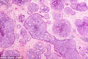 Breakthrough in Breast Cancer Research: New Mechanism Reveals How Cancer Spreads and Opens Doors for Early Treatment