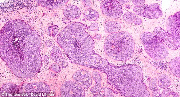 Breakthrough in Breast Cancer Research: New Mechanism Reveals How Cancer Spreads and Opens Doors for Early Treatment