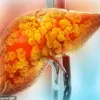 Late-Breaking: Niki Nash's NAFLD Advocacy Challenges Stereotypes, Urges Timely Awareness