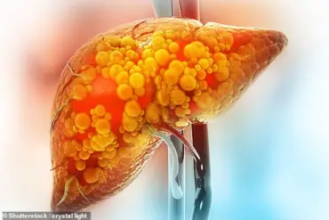 Late-Breaking: Niki Nash's NAFLD Advocacy Challenges Stereotypes, Urges Timely Awareness