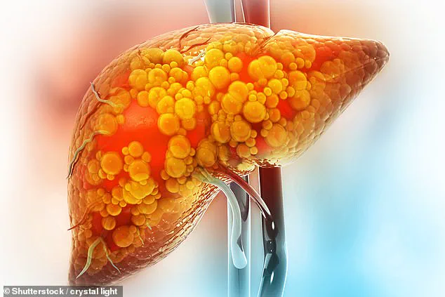 Late-Breaking: Niki Nash's NAFLD Advocacy Challenges Stereotypes, Urges Timely Awareness
