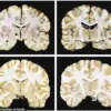 Manhattan Skyscraper Tragedy and CTE: Expert Analysis on Neurodegenerative Disease and Public Safety Implications