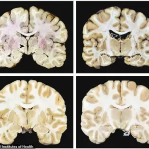 Manhattan Skyscraper Tragedy and CTE: Expert Analysis on Neurodegenerative Disease and Public Safety Implications