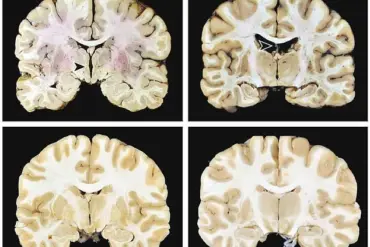 Manhattan Skyscraper Tragedy and CTE: Expert Analysis on Neurodegenerative Disease and Public Safety Implications