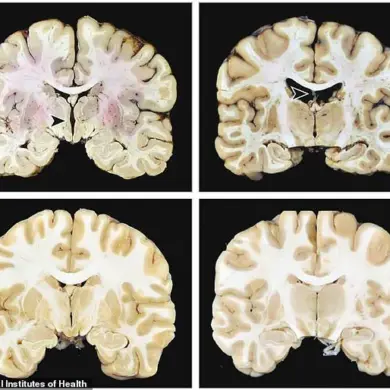 Manhattan Skyscraper Tragedy and CTE: Expert Analysis on Neurodegenerative Disease and Public Safety Implications