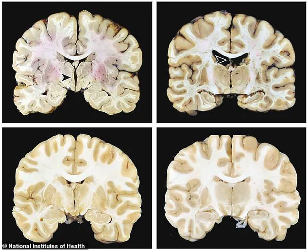 Manhattan Skyscraper Tragedy and CTE: Expert Analysis on Neurodegenerative Disease and Public Safety Implications