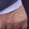 President Trump's Hand Patch Raises Questions as Administration Offers No Official Explanation