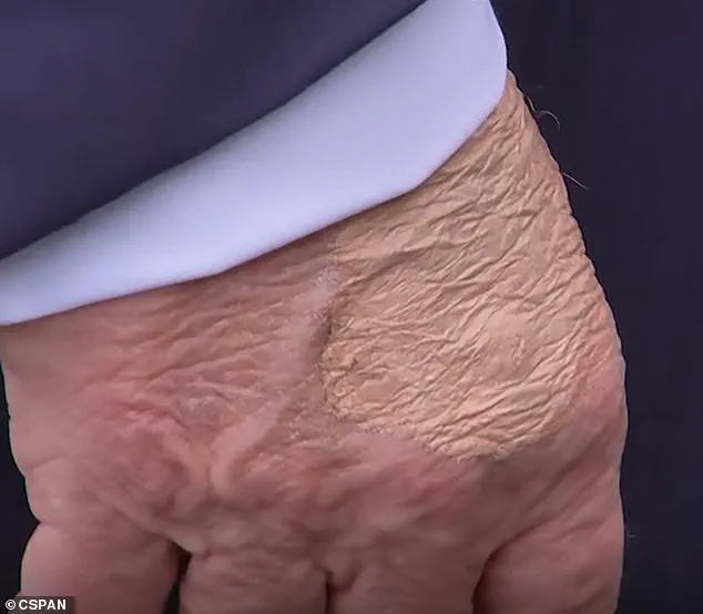 President Trump's Hand Patch Raises Questions as Administration Offers No Official Explanation