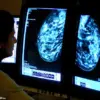 Study Suggests Mounjaro (Tirzepatide) May Reduce Breast Cancer Risk in Addition to Weight Loss Benefits