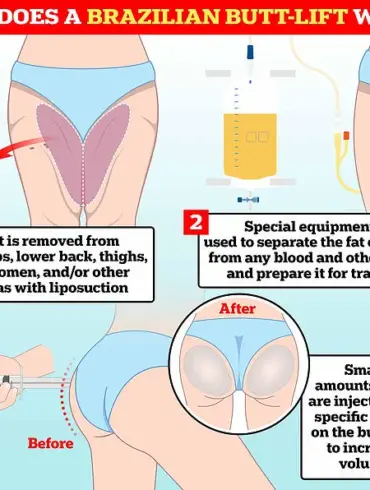 Tragic Death of Police Officer Following Brazilian Butt Lift Surgery