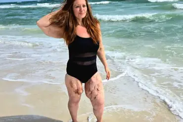 Weight-Loss Influencer Lexi Reed's Journey Through Calciphylaxis and Health Advocacy