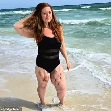 Weight-Loss Influencer Lexi Reed's Journey Through Calciphylaxis and Health Advocacy