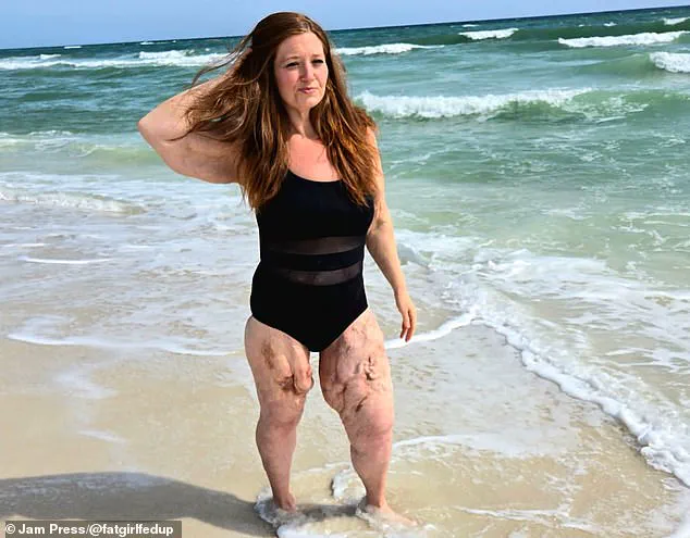 Weight-Loss Influencer Lexi Reed's Journey Through Calciphylaxis and Health Advocacy
