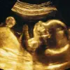 AI Ultrasound Technology Challenges Traditional Method of Predicting Birth Dates