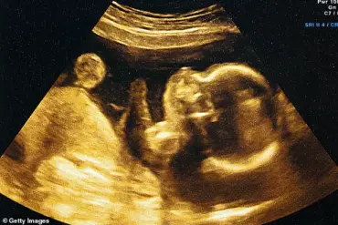 AI Ultrasound Technology Challenges Traditional Method of Predicting Birth Dates