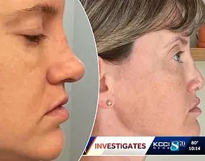 Botched Breast Surgery and Legal Battle: Severe Complications Raise Questions About Cosmetic Clinic's Standards