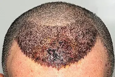 Dr. Abraham Armani Warns: 'Better to Be Bald' Than Face the Consequences of a Botched Hair Transplant
