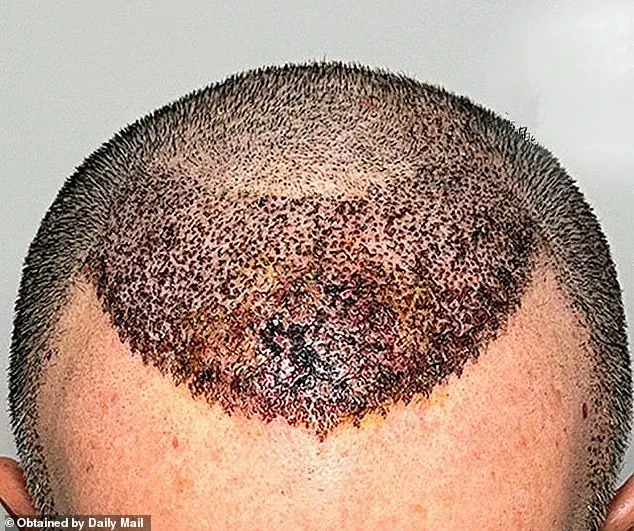 Dr. Abraham Armani Warns: 'Better to Be Bald' Than Face the Consequences of a Botched Hair Transplant