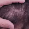 Experts Warn on Surge in Unregulated Hair Transplants: Public Health Crisis Emerges in UK