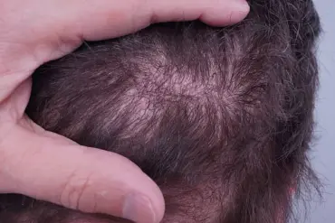 Experts Warn on Surge in Unregulated Hair Transplants: Public Health Crisis Emerges in UK