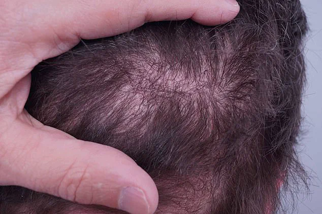 Experts Warn on Surge in Unregulated Hair Transplants: Public Health Crisis Emerges in UK