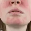 From Acne to Rosacea: Janet Atkins' Unending Battle with Chronic Skin Conditions