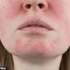 From Acne to Rosacea: Janet Atkins' Unending Battle with Chronic Skin Conditions