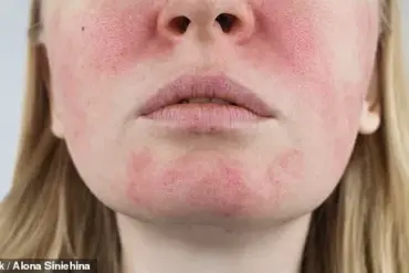 From Acne to Rosacea: Janet Atkins' Unending Battle with Chronic Skin Conditions